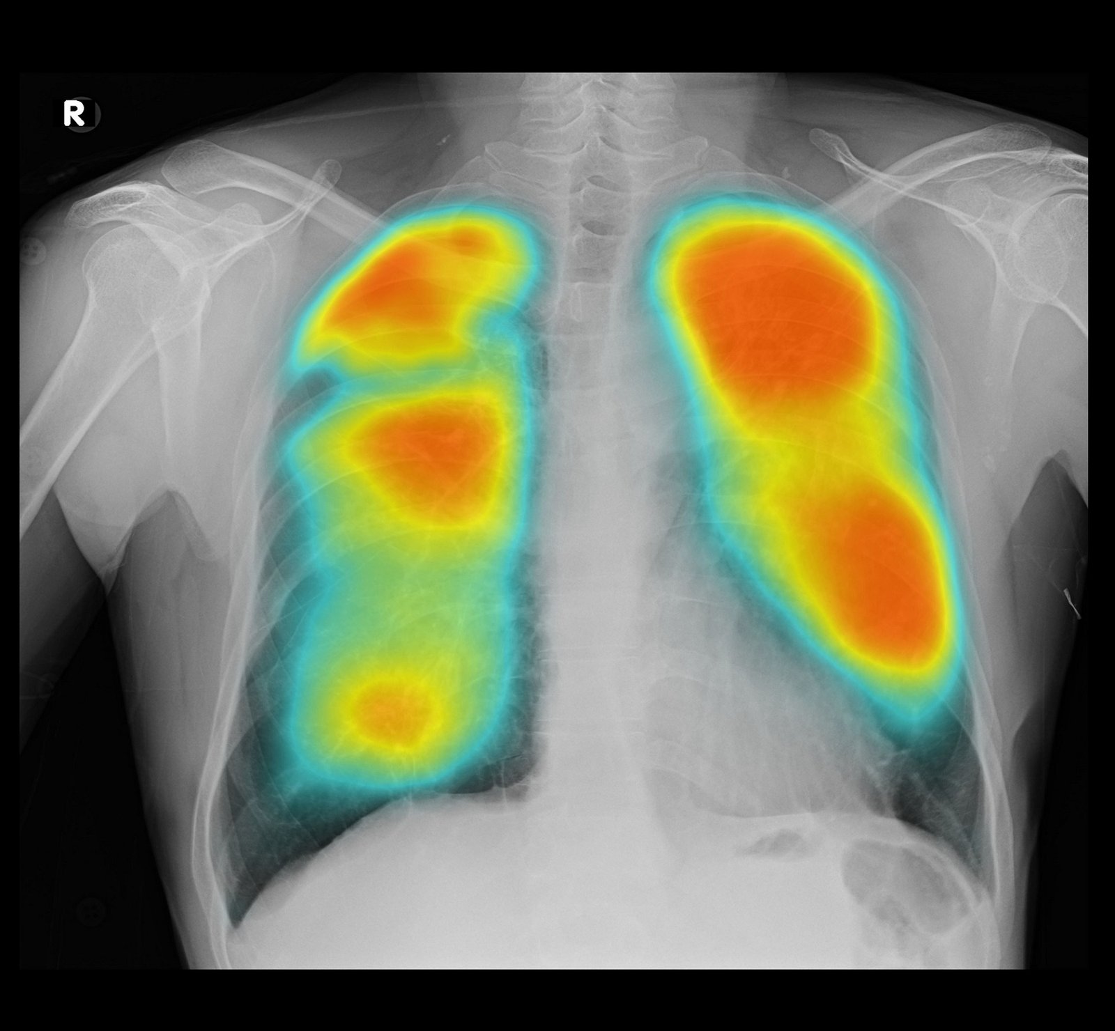 Qure.ai Teams Up with PATH India to Implement AI-Enabled Chest X-Ray Solution for TB and Covid-19 Screening in Maharashtra through Unitaid Funding
